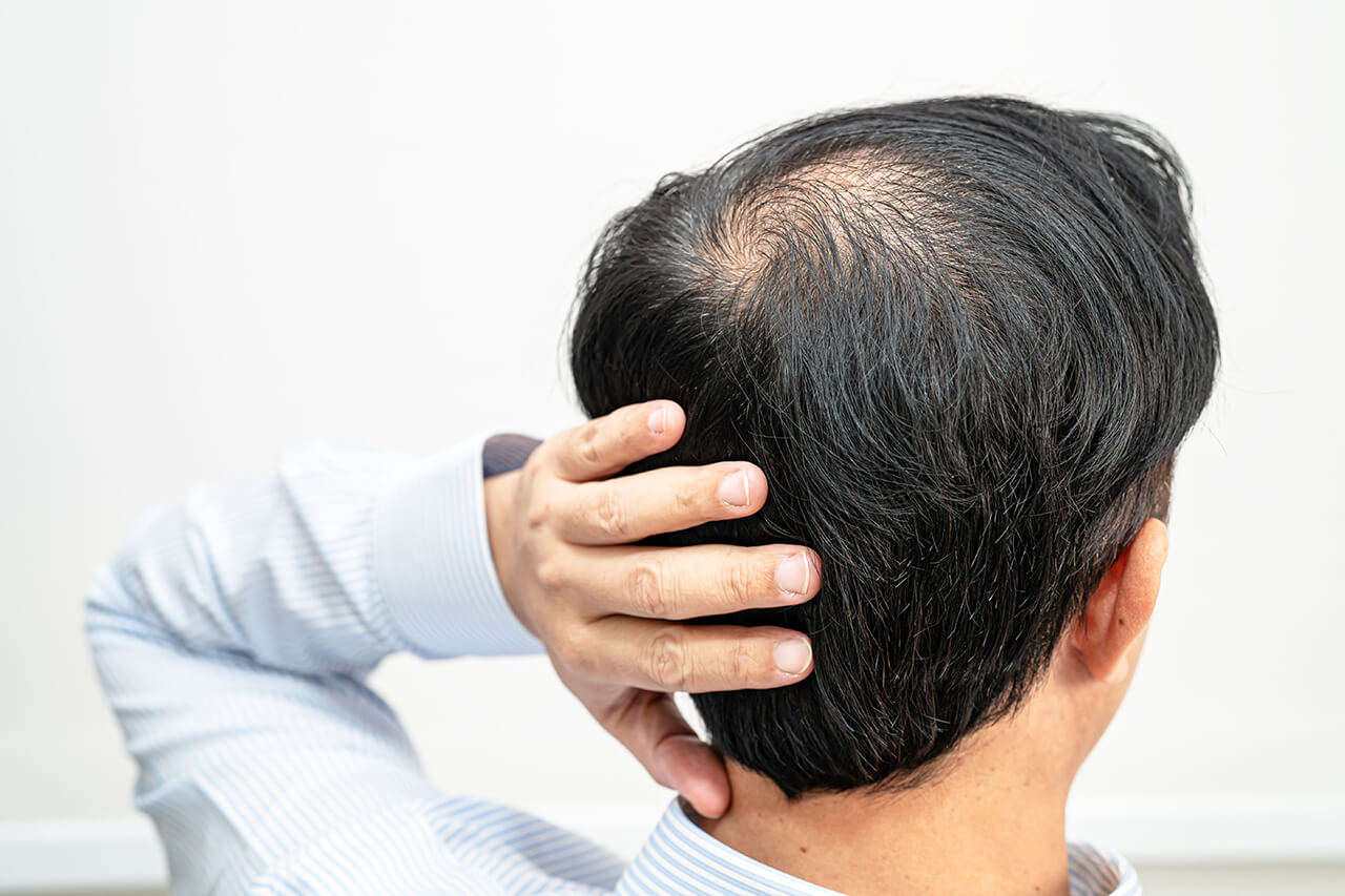 bald-in-the-middle-head-and-begin-no-loss-hair-gla-2024-08-13-04-22-57-utc (1)