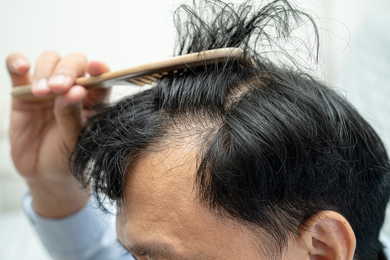 bald-in-the-middle-head-and-begin-no-loss-hair-gla-2024-08-21-21-24-35-utc (1)