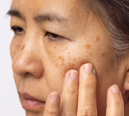 Malasma Dark Spots (1)