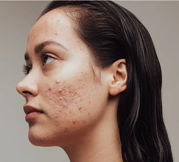 woman acne (1)